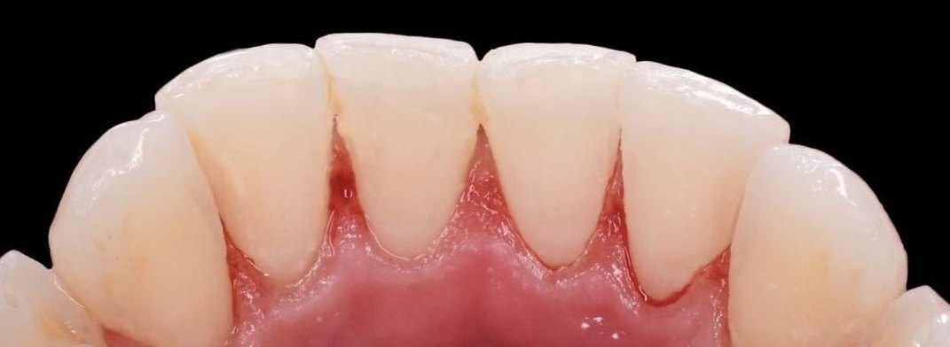 Après : dents du bas nettoyées