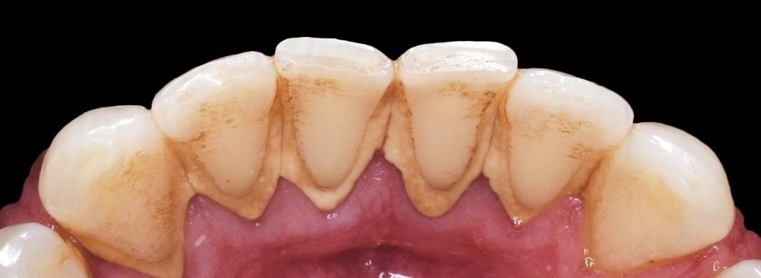 Avant : dents du bas couvertes de tartre