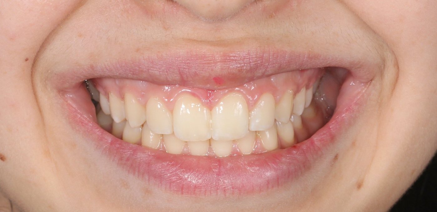 Après : sourire aux dents alignées