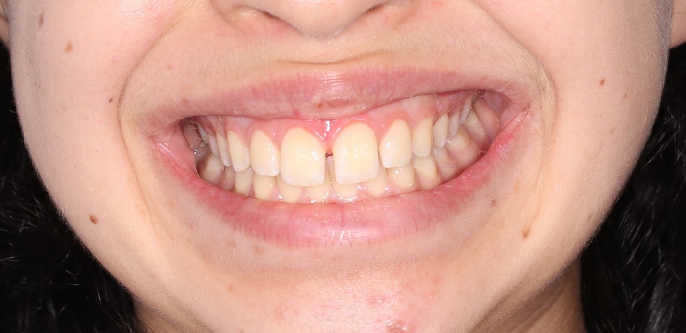Avant : sourire avec un espace entre les incisives