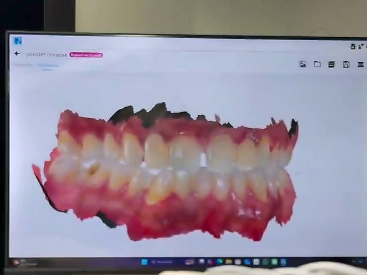 Écran affichant le scan 3D d'une arcade dentaire