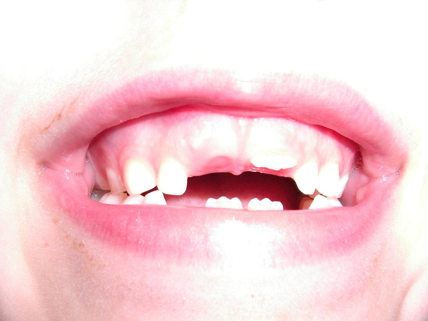 Sourire d'enfant avec des dents de lait qui tombent