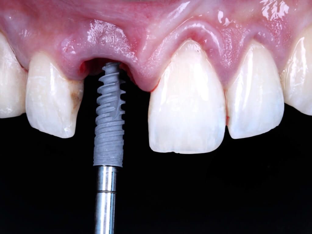 Pose d'un implant dentaire à Meknès