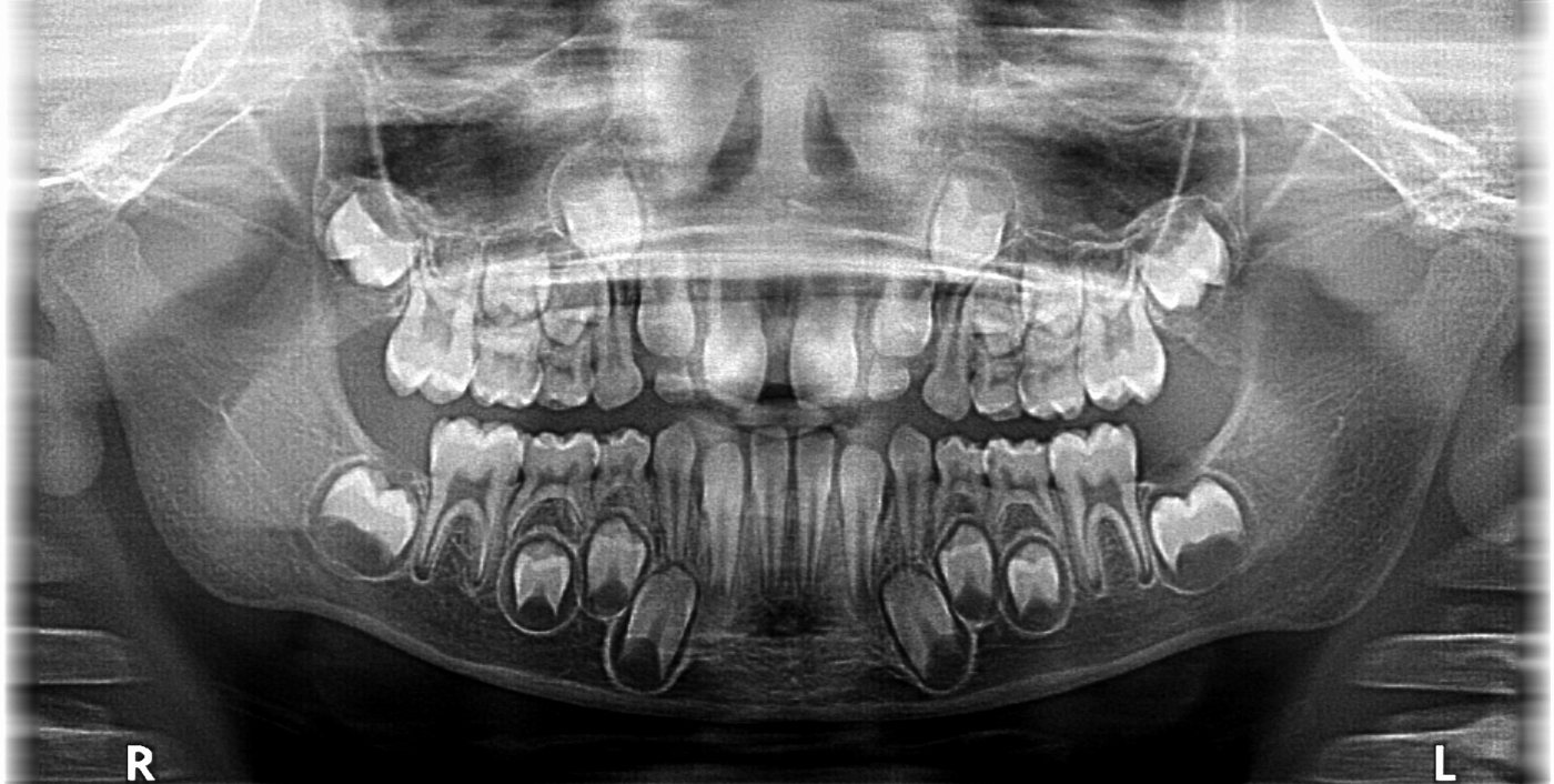 Radiographie d'une dentition mixte d'enfant